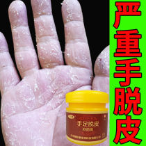 Hand itching peeling dry hand peeling dry hand seasonal small blisters anti-itching cream