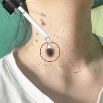 (Wei Ya recommended) dont go back and remove all the black spots on your face.