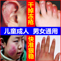 Frostbite cream antipruritic frostbite cream root swelling childrens face ears hands feet and heels