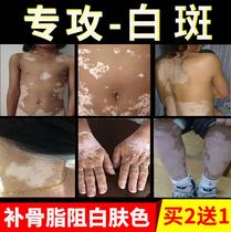 Treatment of vitiligo Monk white spot special medicine for melanin growth skin ointment white epilepsy ointment white epilepsy ointment