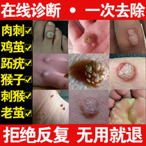 Prick removal cream Prick monkey removal point treatment of female monkey Plantar wart patch spirit hands and feet take a potion medicine