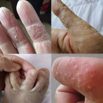 Watsons hand peeling skin cracking foot dry finger peeling skin peeling skin molting repair cream