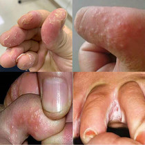 Hand peeling repair cream seasonal palm finger molting cracking chapping vitamin fading peeling peeling bursting skin