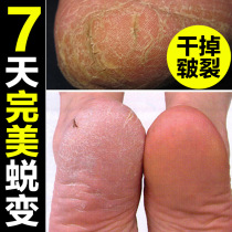 foot mask dry treatment jiao gan lie peeling jiao qi gao antipruritic cream mens anti-dry water fungi antipruritic