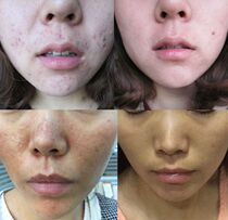 Hanfang Fukang Liquid Hormone Face Acne acne to remove red and itchy red blood