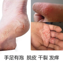 Finger molting cracking cream cracking hands and feet anti-cracking dry and cracked feet dry and rough skin peeling cream repair cream