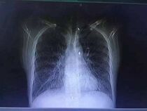 Hunan Wulong Mountain Chinese herbal medicine lung nodules