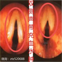 Sound with swollen small knot and blood edema acute and chronic pharyngitis Chinese herbal medicine Pantomime sound hoarse and thick sandal