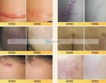 s Nuobisong face care acne scar removal cream Acne Spots s