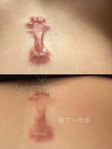 10 pieces of Japanese Emperor incision scar patch Chest scar cream patch Crab foot swelling patch Acne scar cream invisible patch