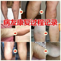 Fushen vein out of the ointment earthworm legs Green tendons swelling red blood Repair Cream external calf spermatic cord