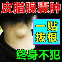 Removal of sebaceous gland cyst plaster antipyridoma subcutaneous cyst pulling poison artifact special drug for the treatment of acne fire boils