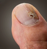 (Drop one drop) Where not to net drop Where to quickly bacteriostatic and dispel the black nail Potassium potassium clear buy 2 sending 1