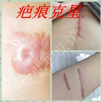Light scar surgery scar special scar Ba Fuping to scar paste bump repair pimple removal