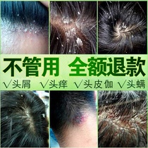 Anti-dandruff artifact medicine treatment of severe dandruff Special medicine Anti-dandruff anti-itching oil control shampoo for men and women
