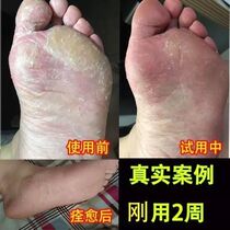 Foot cream spray anti-itching and peeling erosive bubble type foot powder foam foot bag special effect foot odor to death skin