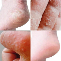 Finger crack dry foot molting peeling itching rough skin dry skin Palm hand peeling skin repair cream