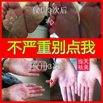 Shu San Shu He Sanhe antibacterial combination Flagship store Speed Tu Shi small blue bottle Zhonghong small green box Foot itching gas