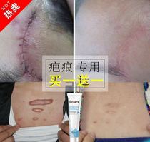 Removal of hyperplastic pimples chest bulge Repair Cream suture needle surgical depression old scar Scar Scar scars