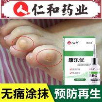 Foot Upper Flesh Thorn Monkey Special Emergency Eyes No Pain Toenails With Chicken Eye Cream To Root Footbed Metatarsus Softener Softener