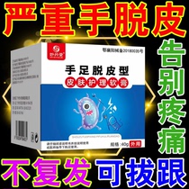Hand peeling ointment blisters severe dry cracking vitamin true## Bacterial infection hand and foot bacteriostatic emollient cream
