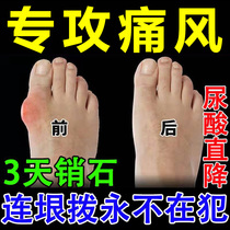 Gout Cold Compress Gel New effect Drug toe Toes Swelling Finger Joints Coarse large deformation Pain Relieving Stoneware XZ