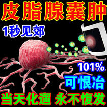 (101% full healing) hypodermic subcutaneous sebaceous gland cyst acne clogging removal of poison plaster patch artifact