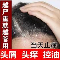 Scalp moss ringworm antifungal shampoo Medicine Large dandruff antipruritic removal of mite hair follicles special ointment Sulfur