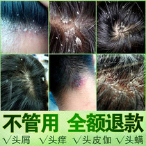 Anti-dandruff and anti-itching shampoo medicine to treat severe dandruff and itch medicine for large scalp Men and women special artifact
