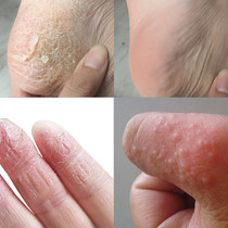 2020 Shake the same palm fingers hands hands skin off soles of the feet dry peeling molting explosive skin peeling cream repair cream