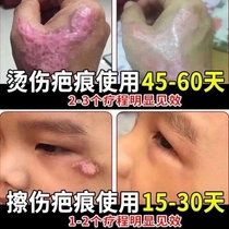 Nanjing Tongrentang to scar ointment scar surgery bump hyperplasia scar Lingyichi erase Special Old Scar Repair