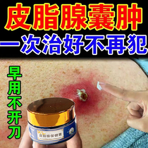 Sebaceous cyst cream removing subcutaneous cyst powder tumor pustulous acne acne fire boil pulling pus extraction poison artifact cream