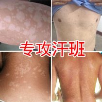 Special medicine for sweat spots Japanese skin brown flower Moss white spot ointment Hanban sweat spot Dew net