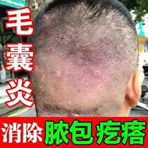 Scalp head ringworm back pimple red dot repair acne ointment for external use