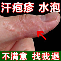 Small blisters on sweaty hands Peeling hands Seasonal itchy fingers Sweat cream anti-itch medicine